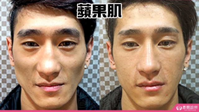 蘋果肌-豐頰-下垂-凹陷-玻尿酸-嬰兒肥-幼態臉-3D無痕筋膜提升-推薦-醫生-效果-彥靚-診所-114081112