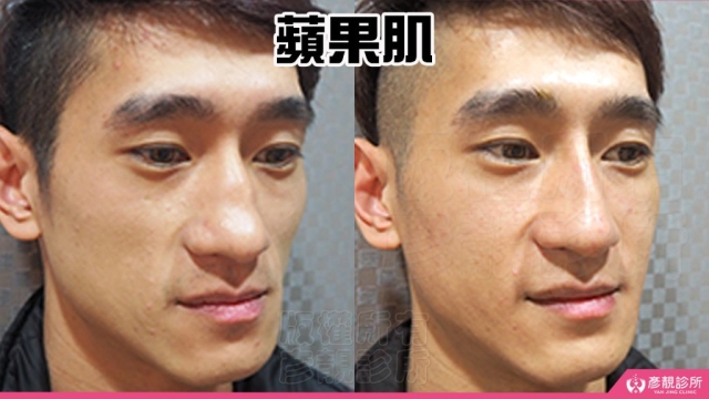 蘋果肌-豐頰-下垂-凹陷-玻尿酸-嬰兒肥-幼態臉-3D無痕筋膜提升-推薦-醫生-效果-彥靚-診所-114081114