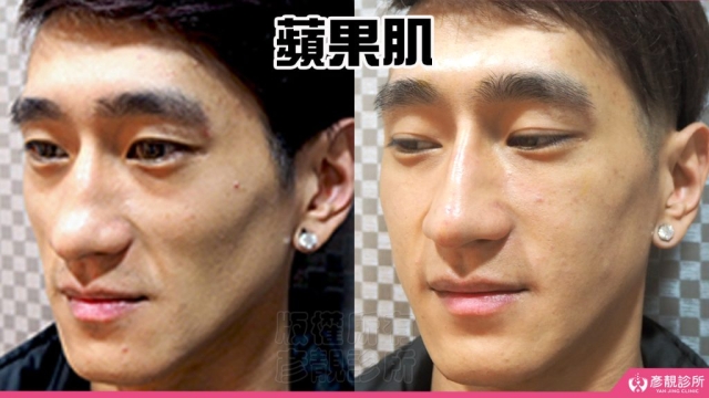 蘋果肌-豐頰-下垂-凹陷-玻尿酸-嬰兒肥-幼態臉-3D無痕筋膜提升-推薦-醫生-效果-彥靚-診所-114081115