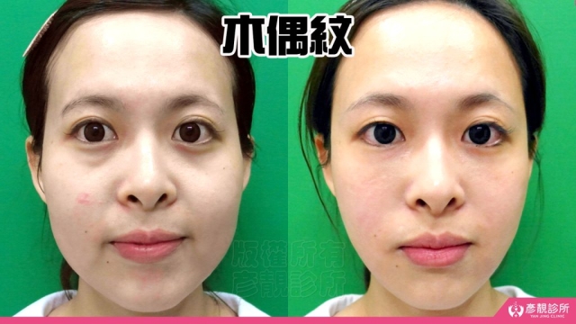 木偶紋-法令紋-三八紋-失敗-玻尿酸-幼態臉-3D無痕筋膜提升-音波-鳳凰電波-拉提-拉皮-手術-推薦-台北-桃園-新竹後保養-醫美-評價-彥靚-診所-醫師-醫生-ptt-dcard-114080401