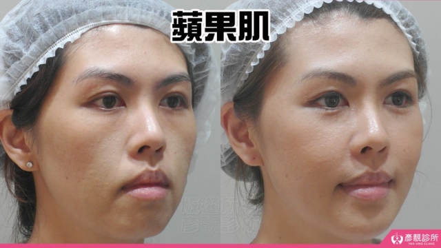 蘋果肌-豐頰-下垂-凹陷-玻尿酸-嬰兒肥-幼態臉-3D無痕筋膜提升-推薦-醫生-效果-彥靚-診所-114081108
