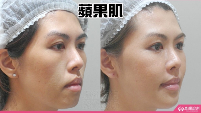蘋果肌-豐頰-下垂-凹陷-玻尿酸-嬰兒肥-幼態臉-3D無痕筋膜提升-推薦-醫生-效果-彥靚-診所-114081111