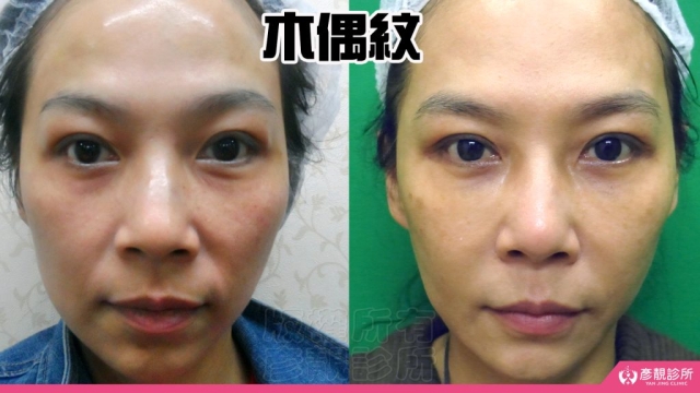 木偶紋-法令紋-三八紋-失敗-玻尿酸-幼態臉-3D無痕筋膜提升-音波-鳳凰電波-拉提-拉皮-手術-推薦-台北-桃園-新竹後保養-醫美-評價-彥靚-診所-醫師-醫生-ptt-dcard-114081101