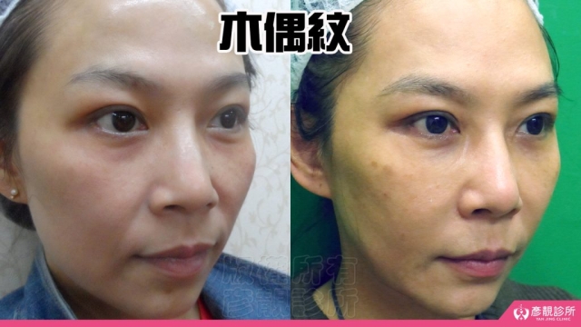 木偶紋-法令紋-三八紋-失敗-玻尿酸-幼態臉-3D無痕筋膜提升-音波-鳳凰電波-拉提-拉皮-手術-推薦-台北-桃園-新竹後保養-醫美-評價-彥靚-診所-醫師-醫生-ptt-dcard-114081102