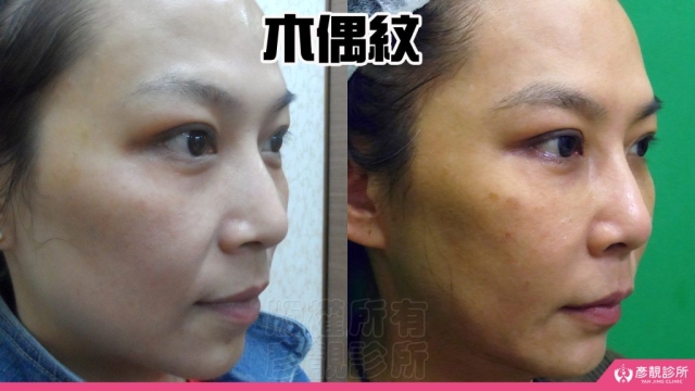 木偶紋-法令紋-三八紋-失敗-玻尿酸-幼態臉-3D無痕筋膜提升-音波-鳳凰電波-拉提-拉皮-手術-推薦-台北-桃園-新竹後保養-醫美-評價-彥靚-診所-醫師-醫生-ptt-dcard-114081103