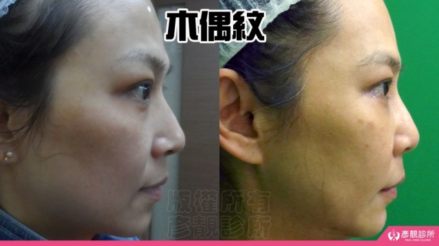 木偶紋-法令紋-三八紋-失敗-玻尿酸-幼態臉-3D無痕筋膜提升-音波-鳳凰電波-拉提-拉皮-手術-推薦-台北-桃園-新竹後保養-醫美-評價-彥靚-診所-醫師-醫生-ptt-dcard-114081104