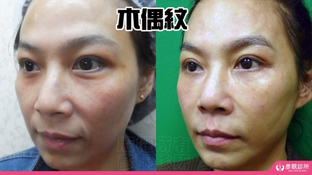 木偶紋-法令紋-三八紋-失敗-玻尿酸-幼態臉-3D無痕筋膜提升-音波-鳳凰電波-拉提-拉皮-手術-推薦-台北-桃園-新竹後保養-醫美-評價-彥靚-診所-醫師-醫生-ptt-dcard-114081105