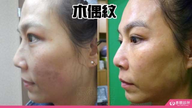 木偶紋-法令紋-三八紋-失敗-玻尿酸-幼態臉-3D無痕筋膜提升-音波-鳳凰電波-拉提-拉皮-手術-推薦-台北-桃園-新竹後保養-醫美-評價-彥靚-診所-醫師-醫生-ptt-dcard-114081107
