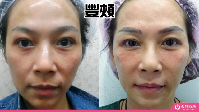 蘋果肌-豐頰-下垂-凹陷-玻尿酸-嬰兒肥-幼態臉-3D無痕筋膜提升-推薦-醫生-效果-彥靚-診所-1140811001