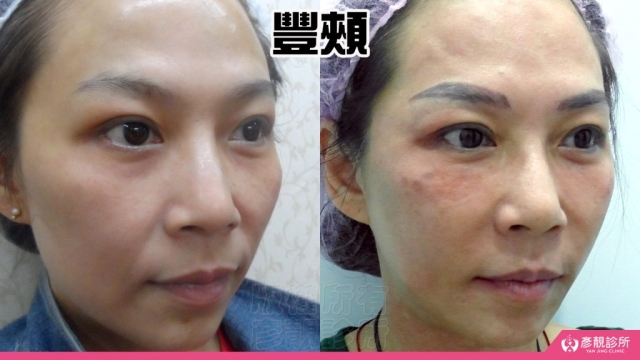蘋果肌-豐頰-下垂-凹陷-玻尿酸-嬰兒肥-幼態臉-3D無痕筋膜提升-推薦-醫生-效果-彥靚-診所-1140811002
