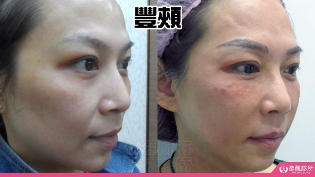 蘋果肌-豐頰-下垂-凹陷-玻尿酸-嬰兒肥-幼態臉-3D無痕筋膜提升-推薦-醫生-效果-彥靚-診所-1140811003