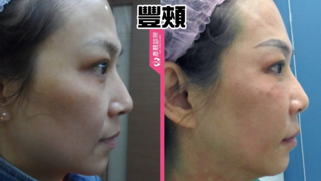 蘋果肌-豐頰-下垂-凹陷-玻尿酸-嬰兒肥-幼態臉-3D無痕筋膜提升-推薦-醫生-效果-彥靚-診所-1140811004