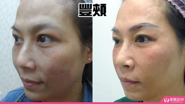 蘋果肌-豐頰-下垂-凹陷-玻尿酸-嬰兒肥-幼態臉-3D無痕筋膜提升-推薦-醫生-效果-彥靚-診所-1140811005