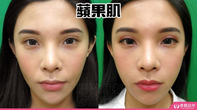 蘋果肌 蘋果肌-豐頰-下垂-凹陷-玻尿酸-嬰兒肥-幼態臉-3D無痕筋膜提升-推薦-醫生-效果-彥靚-診所-114081108