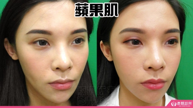 蘋果肌 蘋果肌-豐頰-下垂-凹陷-玻尿酸-嬰兒肥-幼態臉-3D無痕筋膜提升-推薦-醫生-效果-彥靚-診所-114081109