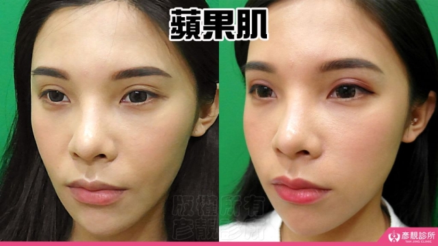 蘋果肌 蘋果肌-豐頰-下垂-凹陷-玻尿酸-嬰兒肥-幼態臉-3D無痕筋膜提升-推薦-醫生-效果-彥靚-診所-114081110
