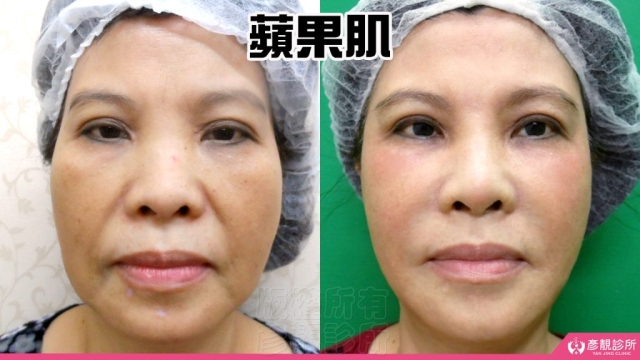 蘋果肌 蘋果肌-豐頰-下垂-凹陷-玻尿酸-嬰兒肥-幼態臉-3D無痕筋膜提升-推薦-醫生-效果-彥靚-診所-114081111