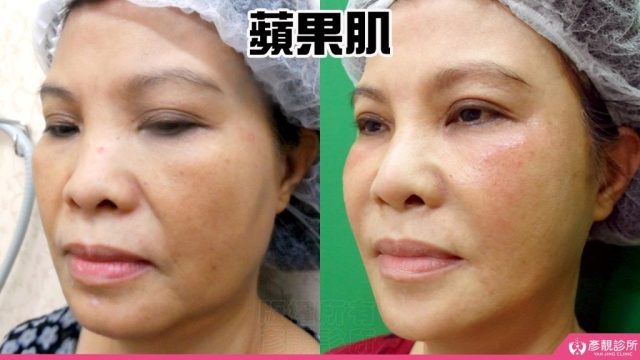 蘋果肌 蘋果肌-豐頰-下垂-凹陷-玻尿酸-嬰兒肥-幼態臉-3D無痕筋膜提升-推薦-醫生-效果-彥靚-診所-114081112