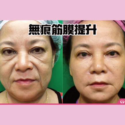 什麼是無痕筋膜提升?效果、維持時間、費用、台灣醫師推薦嗎?眾多案例分享 8 無痕 筋膜提升 幼態臉 饅化 埋線 音波 鳳凰電波 拉皮 拉提 玻尿酸 彥靚 診所 醫生 醫師 推薦 效果 台北 桃園 新竹 消除改善 副作用併發症後遺症 心得 評價 ptt dcard 0812