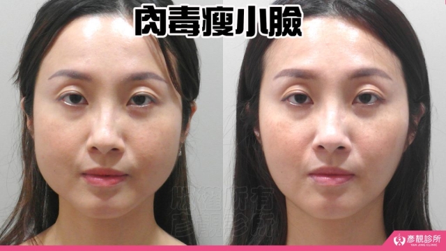 瘦小臉-保妥適-肉毒桿菌-音波-拉提-拉皮-咀嚼肌-推薦-肉毒-除皺-台北-桃園-新竹-評價-彥靚-幼態臉-3D無痕筋膜提升-診所-醫師-醫生-失敗-心得-分享-ptt-114080405