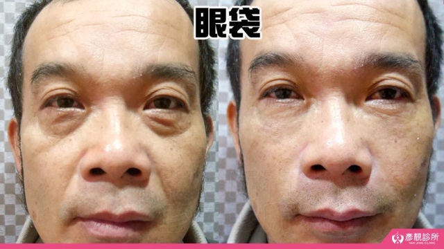 淚溝-眼袋-黑眼圈-失敗-玻尿酸-手術-推薦-幼態臉-3D無痕筋膜提升-消除改善-價格費用-台北-桃園-新竹-術後保養-評價-彥靚-診所-醫師-醫生-副作用併發症後遺症-心得-分享-dcard-ptt-30
