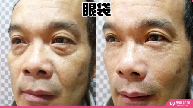 淚溝-眼袋-黑眼圈-失敗-玻尿酸-手術-推薦-幼態臉-3D無痕筋膜提升-消除改善-價格費用-台北-桃園-新竹-術後保養-評價-彥靚-診所-醫師-醫生-副作用併發症後遺症-心得-分享-dcard-ptt-31