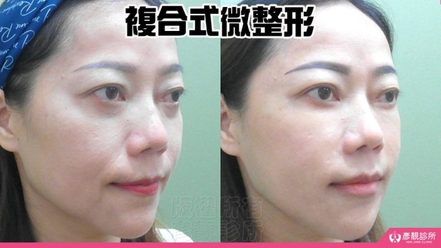 複合式-微整形-玻尿酸-手術-推薦-消除改善-幼態臉-3D無痕筋膜提升-價格費用-台北-桃園-新竹-術後保養-評價-彥靚-診所-副作用併發症後遺症-醫師-醫生-心得-分享-114080402
