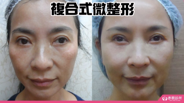 複合式-微整形-玻尿酸-手術-推薦-消除改善-幼態臉-3D無痕筋膜提升-價格費用-台北-桃園-新竹-術後保養-評價-彥靚-診所-副作用併發症後遺症-醫師-醫生-心得-分享-114080403
