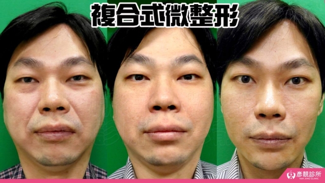 複合式-微整形-玻尿酸-手術-推薦-消除改善-幼態臉-3D無痕筋膜提升-價格費用-台北-桃園-新竹-術後保養-評價-彥靚-診所-副作用併發症後遺症-醫師-醫生-心得-分享-114080404