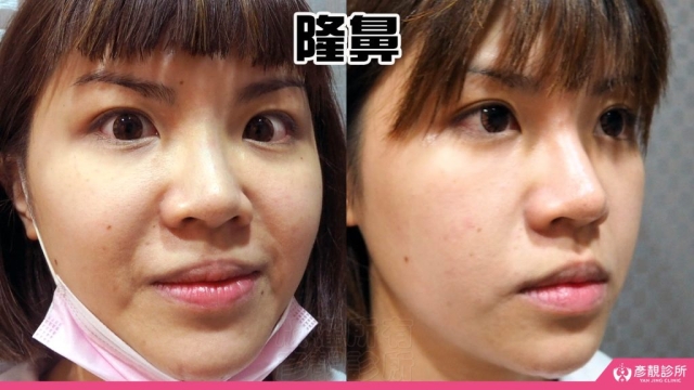 隆鼻-鼻子-鼻基底-山根-鼻頭-縮鼻頭-小翹鼻-玻尿酸-幼態臉-3D無痕筋膜提升-手術-假體-推薦-消除改善-台北-桃園-新竹-彥靚-診所-醫師-醫生-心得-ptt-Dcard-01