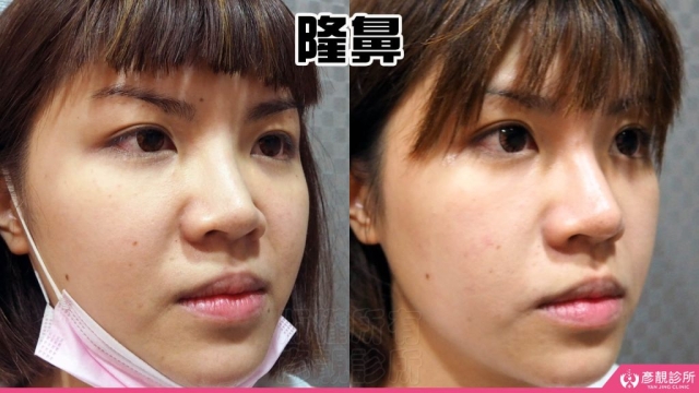 隆鼻-鼻子-鼻基底-山根-鼻頭-縮鼻頭-小翹鼻-玻尿酸-幼態臉-3D無痕筋膜提升-手術-假體-推薦-消除改善-台北-桃園-新竹-彥靚-診所-醫師-醫生-心得-ptt-Dcard-04