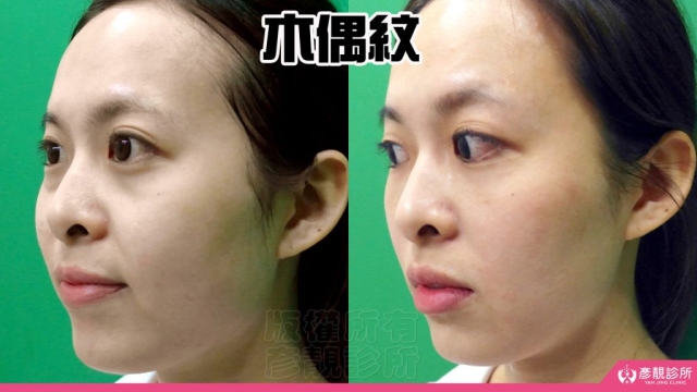 木偶紋-法令紋-三八紋-失敗-玻尿酸-幼態臉-3D無痕筋膜提升-音波-鳳凰電波-拉提-拉皮-手術-推薦-台北-桃園-新竹後保養-醫美-評價-彥靚-診所-醫師-醫生-ptt-dcard-114080405