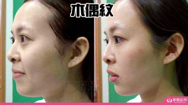 木偶紋-法令紋-三八紋-失敗-玻尿酸-幼態臉-3D無痕筋膜提升-音波-鳳凰電波-拉提-拉皮-手術-推薦-台北-桃園-新竹後保養-醫美-評價-彥靚-診所-醫師-醫生-ptt-dcard-114080406