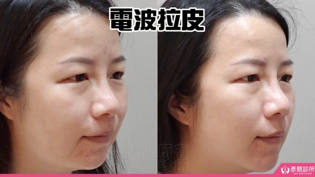 電波-音波-拉提-拉皮-嘴邊肉-雙下巴-法令紋-台北-桃園-新竹-鳳凰電波-幼態臉-3D無痕筋膜提升-醫美-診所-醫生-醫師-推薦-彥靚-消除改善-失敗-效果-分享-ptt-08