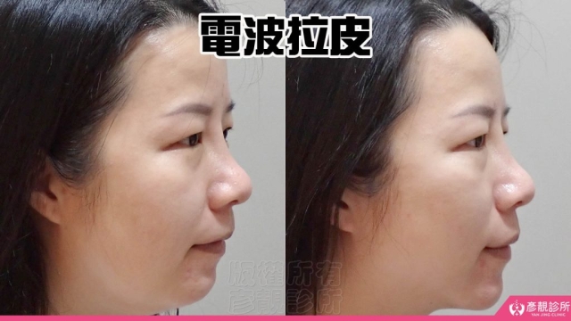 電波-音波-拉提-拉皮-嘴邊肉-雙下巴-法令紋-台北-桃園-新竹-鳳凰電波-幼態臉-3D無痕筋膜提升-醫美-診所-醫生-醫師-推薦-彥靚-消除改善-失敗-效果-分享-ptt-09