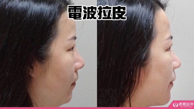 電波-音波-拉提-拉皮-嘴邊肉-雙下巴-法令紋-台北-桃園-新竹-鳳凰電波-幼態臉-3D無痕筋膜提升-醫美-診所-醫生-醫師-推薦-彥靚-消除改善-失敗-效果-分享-ptt-09