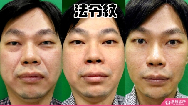 法令紋-失敗-木偶紋-嘴邊肉-玻尿酸- 拉皮-推薦-幼態臉-3D無痕筋膜提升-黃政達-台北-桃園-新竹-術後保養-評價-彥靚-診所-醫師-醫生-心得-分享-ptt-dcard-014