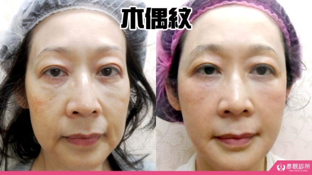 木偶紋-法令紋-三八紋-失敗-玻尿酸-幼態臉-3D無痕筋膜提升-音波-鳳凰電波-拉提-拉皮-手術-推薦-台北-桃園-新竹後保養-醫美-評價-彥靚-診所-醫師-醫生-ptt-dcard-114081108