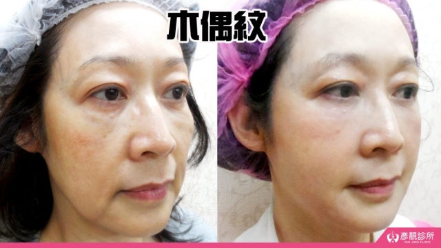 木偶紋-法令紋-三八紋-失敗-玻尿酸-幼態臉-3D無痕筋膜提升-音波-鳳凰電波-拉提-拉皮-手術-推薦-台北-桃園-新竹後保養-醫美-評價-彥靚-診所-醫師-醫生-ptt-dcard-114081109