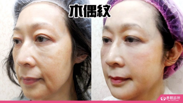 木偶紋-法令紋-三八紋-失敗-玻尿酸-幼態臉-3D無痕筋膜提升-音波-鳳凰電波-拉提-拉皮-手術-推薦-台北-桃園-新竹後保養-醫美-評價-彥靚-診所-醫師-醫生-ptt-dcard-1140811010
