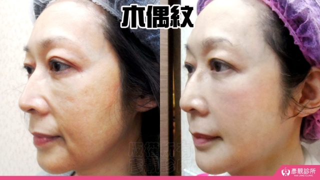 木偶紋-法令紋-三八紋-失敗-玻尿酸-幼態臉-3D無痕筋膜提升-音波-鳳凰電波-拉提-拉皮-手術-推薦-台北-桃園-新竹後保養-醫美-評價-彥靚-診所-醫師-醫生-ptt-dcard-114081111