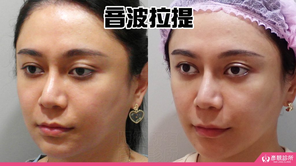 通過音波拉提療程後個案改善了嘴邊肉和下顎線條
