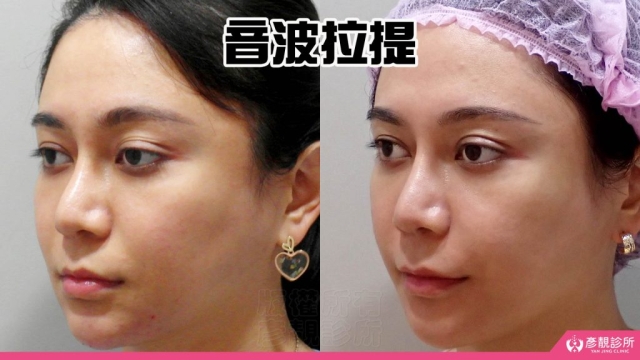 音波-拉提-拉皮-嘴邊肉-雙下巴-法令紋-台北-桃園-新竹-鳳凰電波-幼態臉-3D無痕筋膜提升-醫美-診所-醫生-醫師-推薦-彥靚-消除改善-失敗-效果-分享-ptt-03