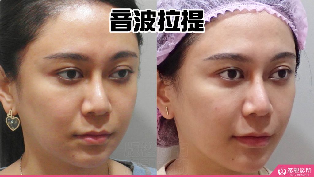 通過音波拉提療程後個案改善了嘴邊肉和下顎線條