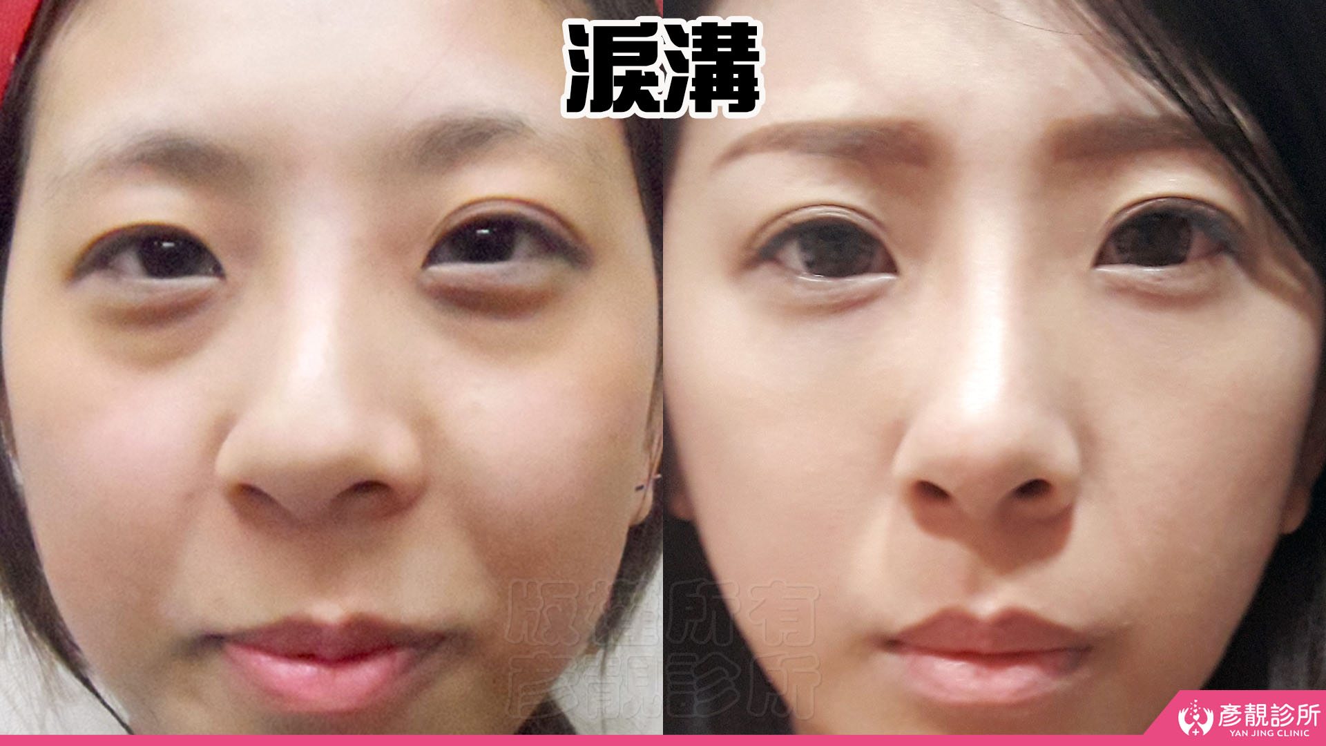 淚溝怎麼改善?先辨黑眼圈成因,再選適合的療程 2 女性眼下淚溝的正面近距離前後對照,左圖下眼瞼隆起與下方凹溝形成明顯陰影,右圖眼下凸凹落差減輕,靠近下睫毛的臥蠶仍有自然層次,說明淚溝改善須兼顧凹陷與相鄰支撐,讓眼神更清爽。