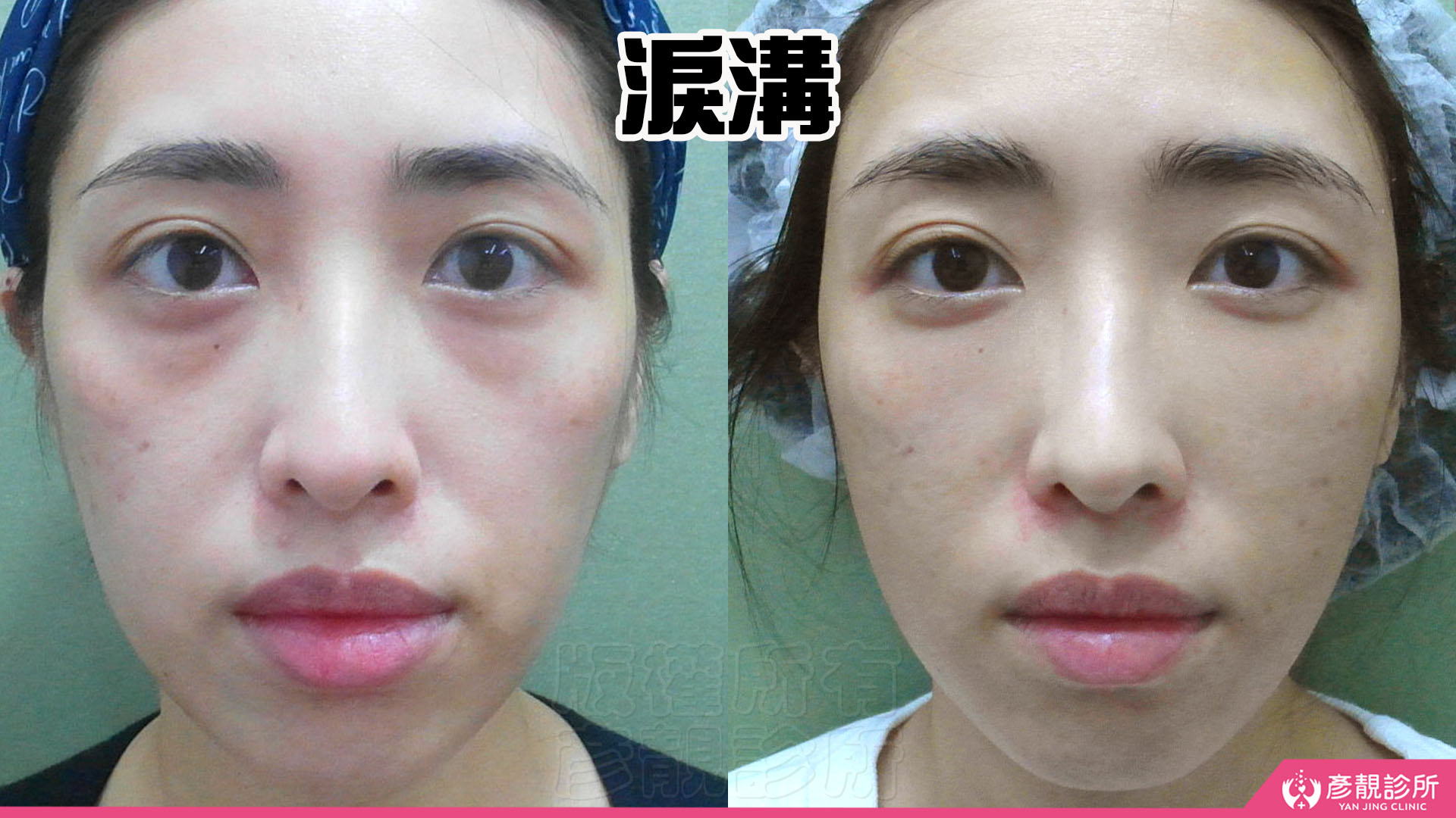 淚溝怎麼改善?先辨黑眼圈成因,再選適合的療程 15 女性單純淚溝改善的術前術後正面對照,左圖眼下凹陷與陰影較明顯,右圖淚溝銜接較平順,同時保留貼近下睫毛的臥蠶隆起與自然分界,呈現淡化疲倦感、維持眼周立體層次的治療目標。