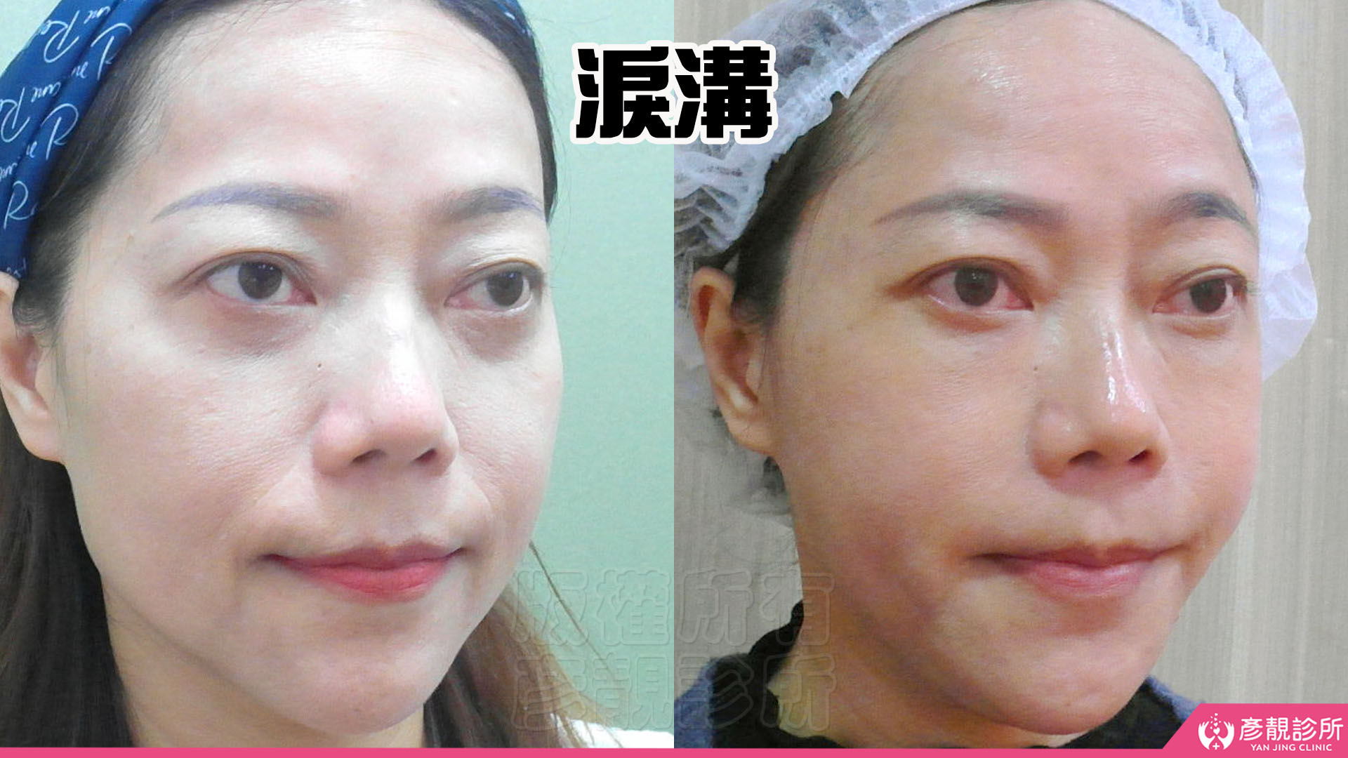 單純型淚溝填充:改善看哪裡?什麼時候需要再補? 7 女性單純型淚溝改善前後,左圖下眼瞼下方的凹陷與淚溝陰影相接,右圖下方凹影減輕,靠近下睫毛的臥蠶與其下緣仍清楚,眼下往臉頰過渡較柔順,呈現補足凹陷同時保留自然臥蠶邊界的結果。