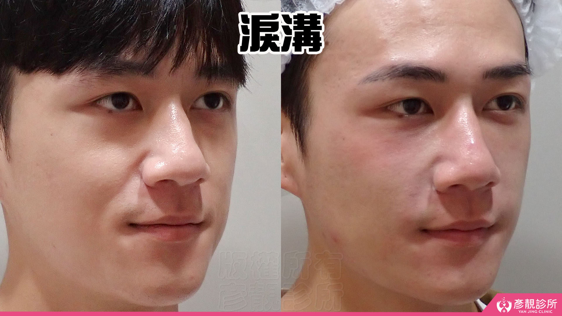 單純型淚溝填充:改善看哪裡?什麼時候需要再補? 3 單純型淚溝開始合併輕微眼袋的男性案例,左圖眼下已有小幅隆起,下方接著淚溝凹影,右圖凹陷與隆起間的落差減輕,眼下銜接較順,呈現由單純凹陷逐步走向溝渠型淚溝的過渡外觀及改善。