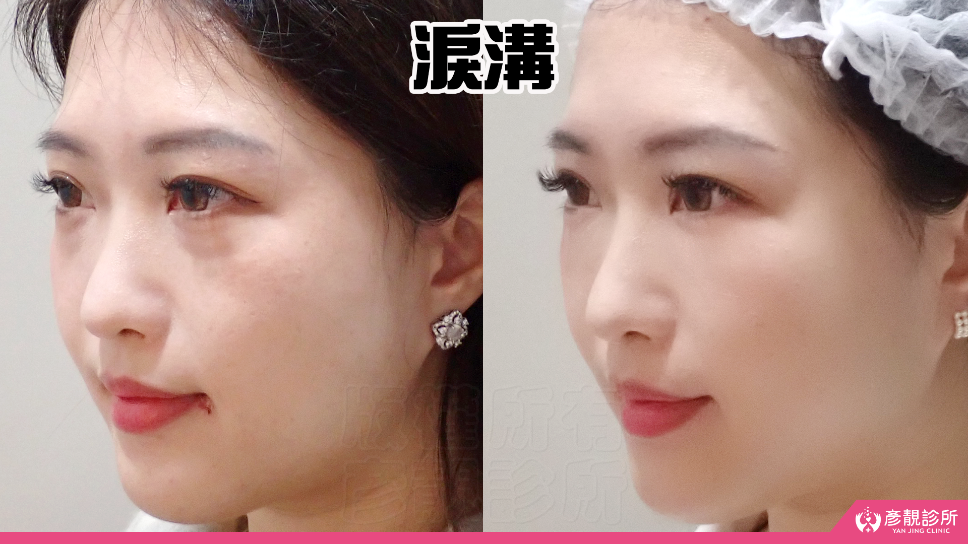 淚溝怎麼改善?先辨黑眼圈成因,再選適合的療程 4 女性淚溝改善的斜側面對照,左圖眼下凹溝及其暗影較明顯,右圖淚溝與上臉頰之間的銜接較柔和,眼下看起來更平順,呈現依組織層次安排填補與支撐,同時保留臥蠶立體度和自然眼周線條的方向。