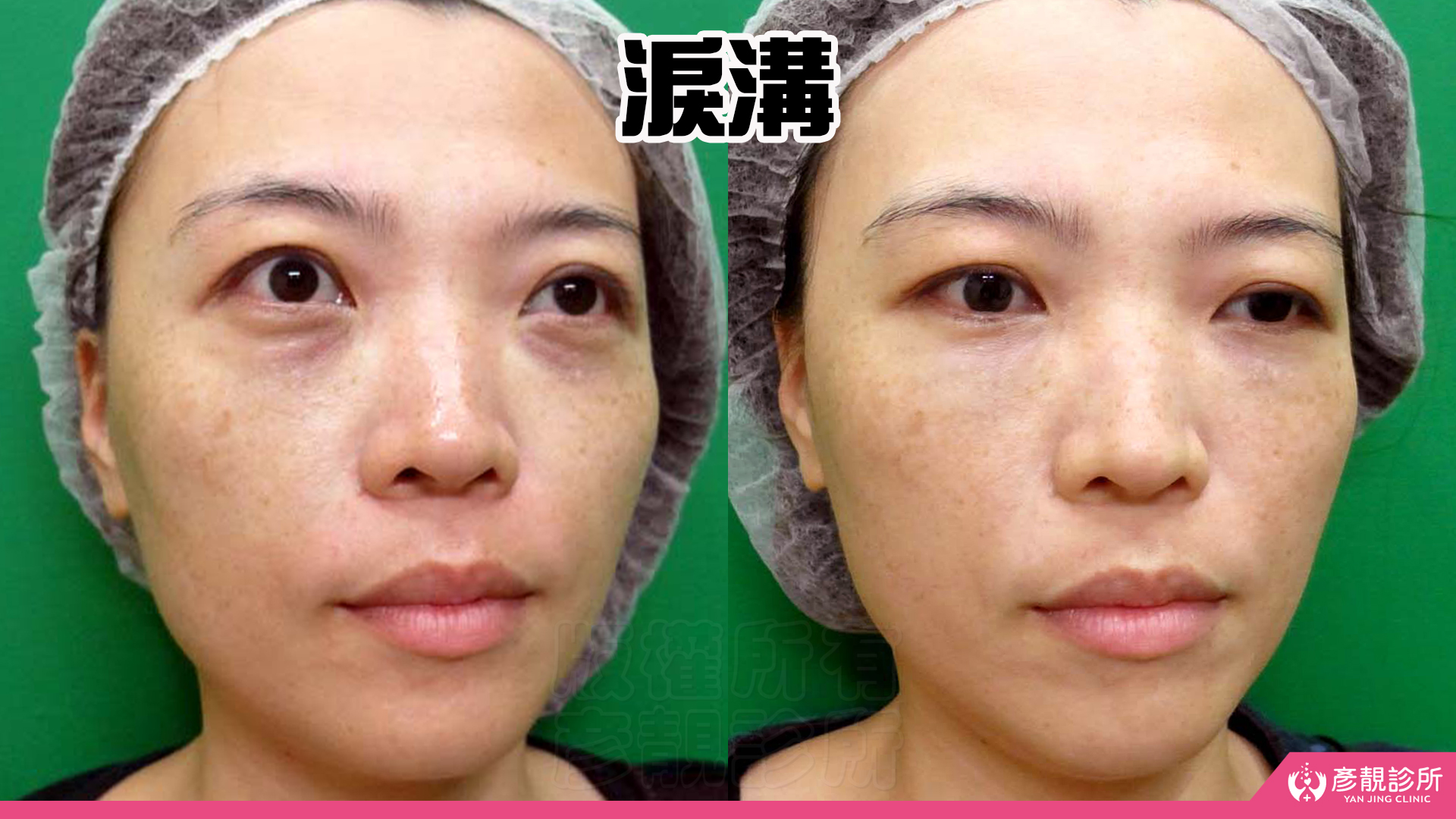單純型淚溝填充:改善看哪裡?什麼時候需要再補? 4 單純型淚溝正面術前術後,左圖雙眼下方的凹陷與深色陰影使眼神顯累,右圖淚溝凹影變淺、眼下接往臉頰較平順,臥蠶邊緣仍有自然起伏,說明改善終點要同時看凹陷減輕與眼周原有線條的保留。